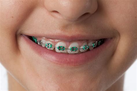 imagenes de brackets